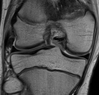 LCL MRI Normal Superior Aspect